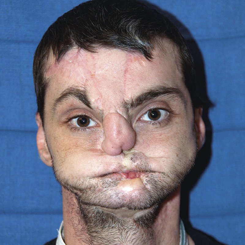 Richard Norris, testimonio de un trasplantado de cara