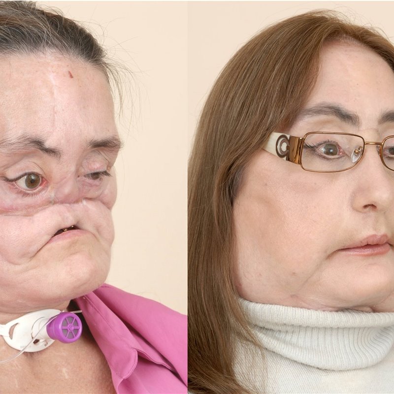Trasplantes faciales, el significado de tener un rostro nuevo