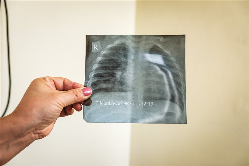 Los médicos revisan  una radiografía de tórax infantil en un hospital de Ulan Bator en busca de signos de neumonía. La contaminación es un factor de riesgo. 