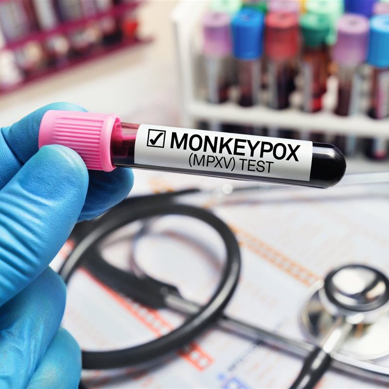 España es uno de los países donde se han detectado más casos de viruela del mono del mundo.