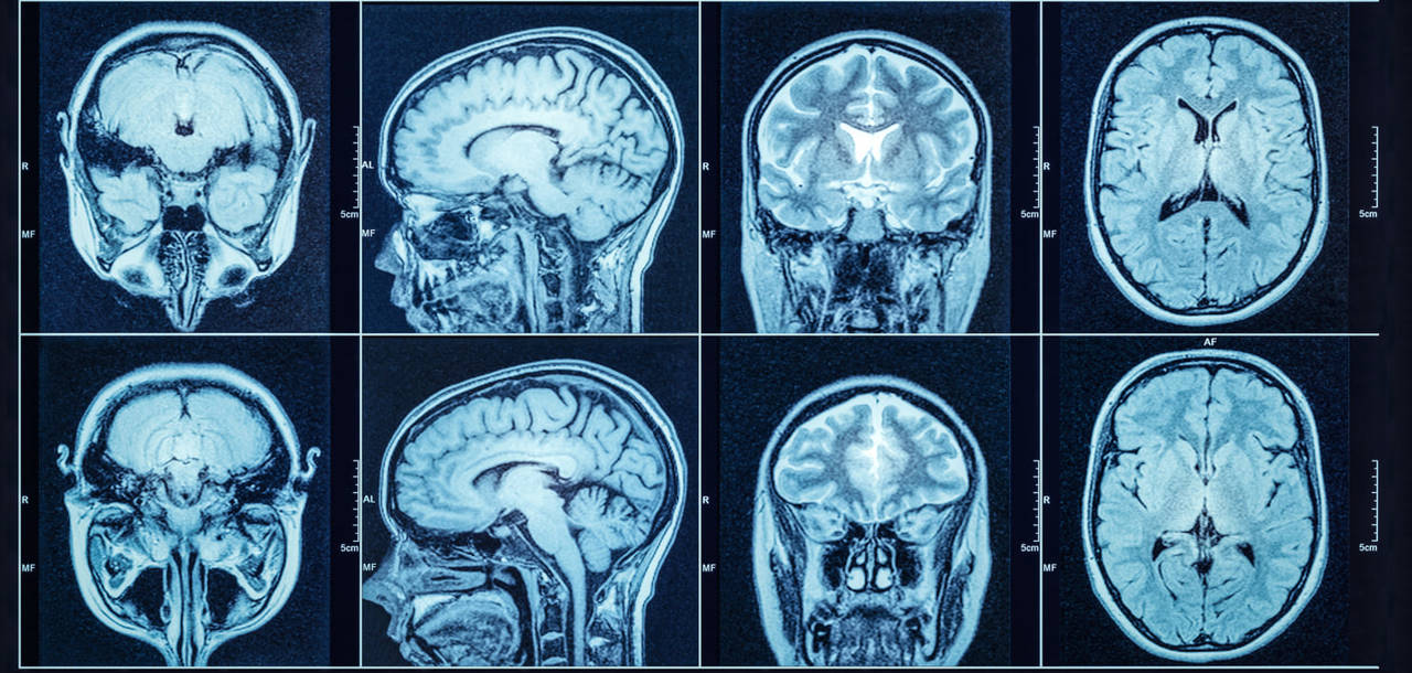 Radiografía cerebro