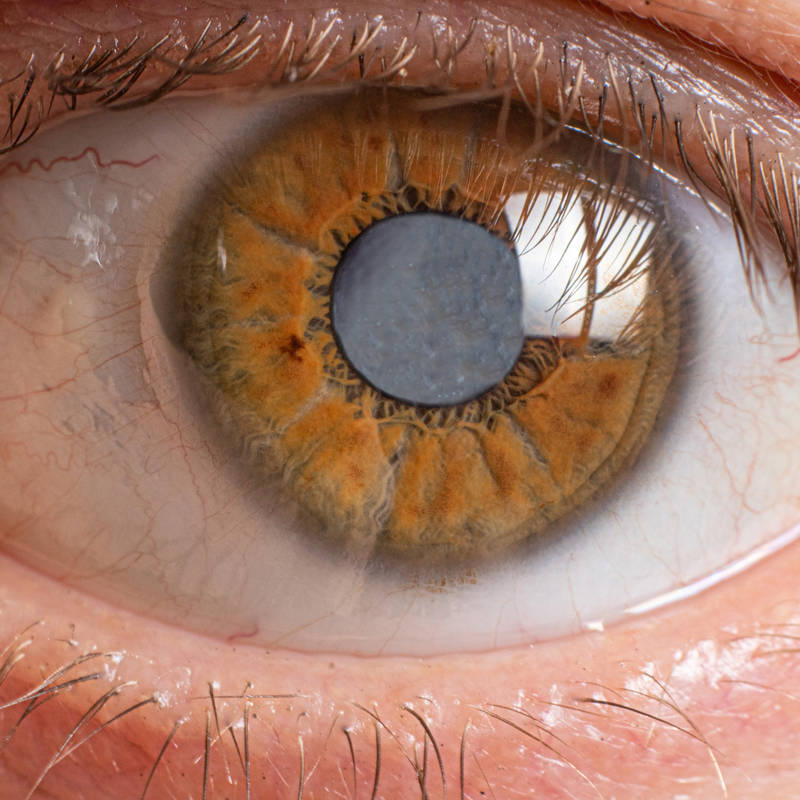 ¿Por qué aparecen las cataratas en los ojos? La ciencia lo explica