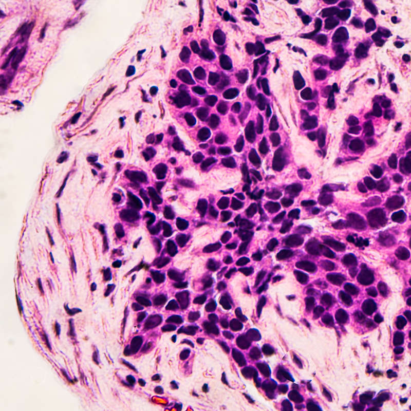 Una nueva era en la detección del cáncer de mama