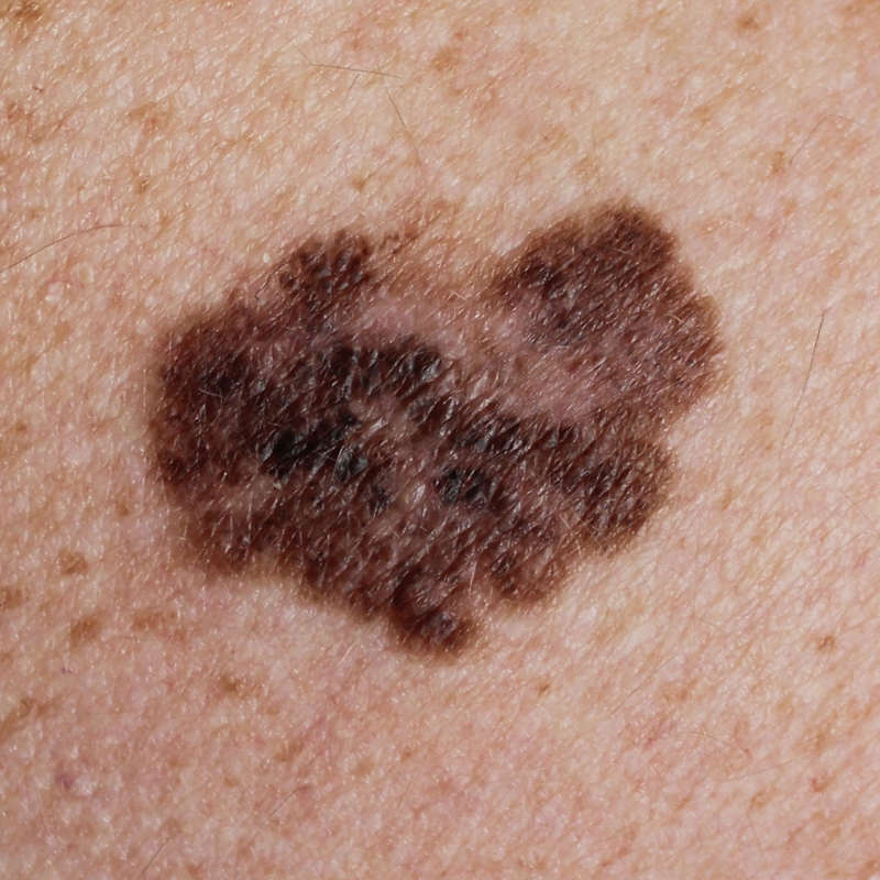 Vacunas contra el melanoma, la esperanza para uno de los cánceres de piel más letales