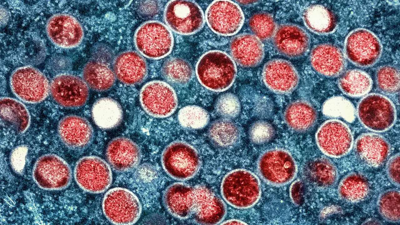 Mpox, la enfermedad que podría convertirse en una amenaza global en caso de expandirse