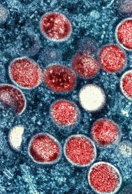 Mpox, la enfermedad que podría convertirse en una amenaza global en caso de expandirse