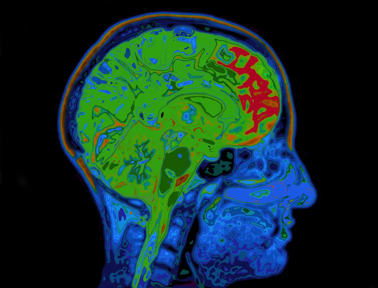 MRI Imagen De La Cabeza Mostrando El Cerebro