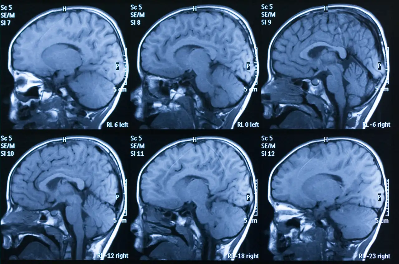 Cerebro scan