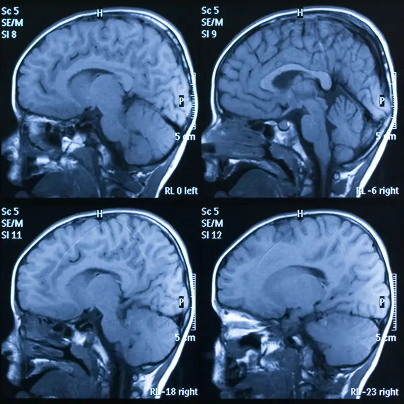 Cerebro scan