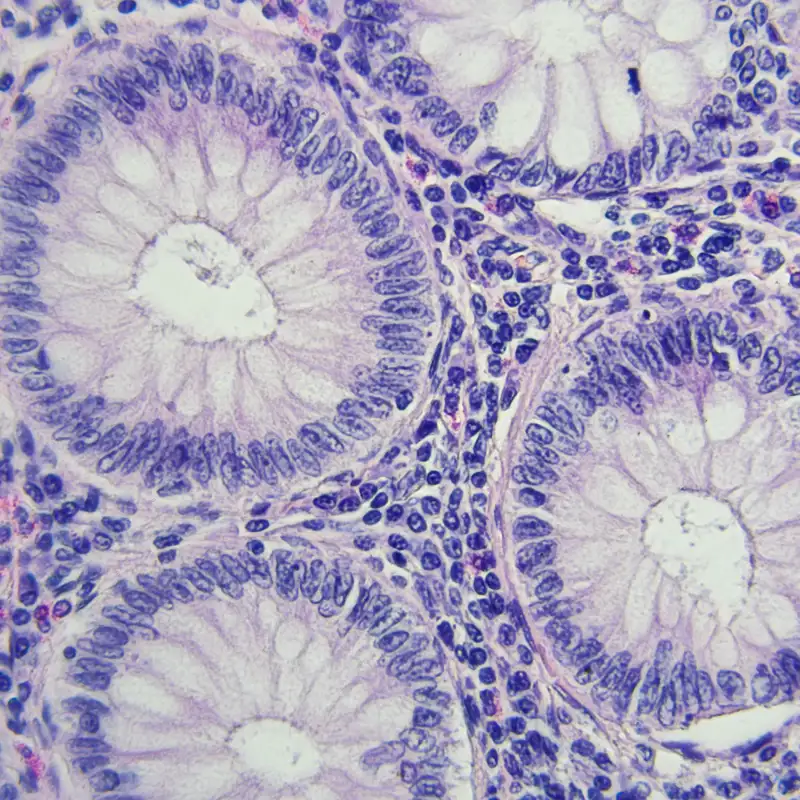 Aumenta la incidencia de cáncer de colon entre jóvenes a nivel global: ¿por qué?