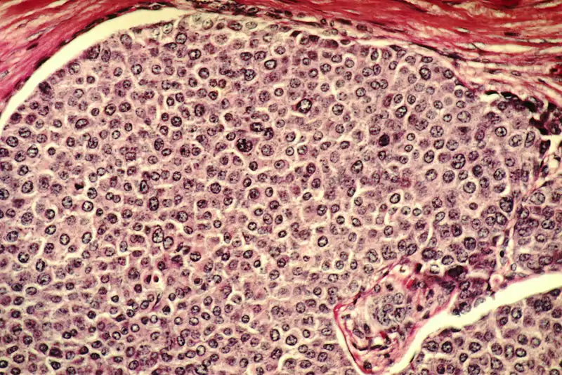Células de cáncer de mama