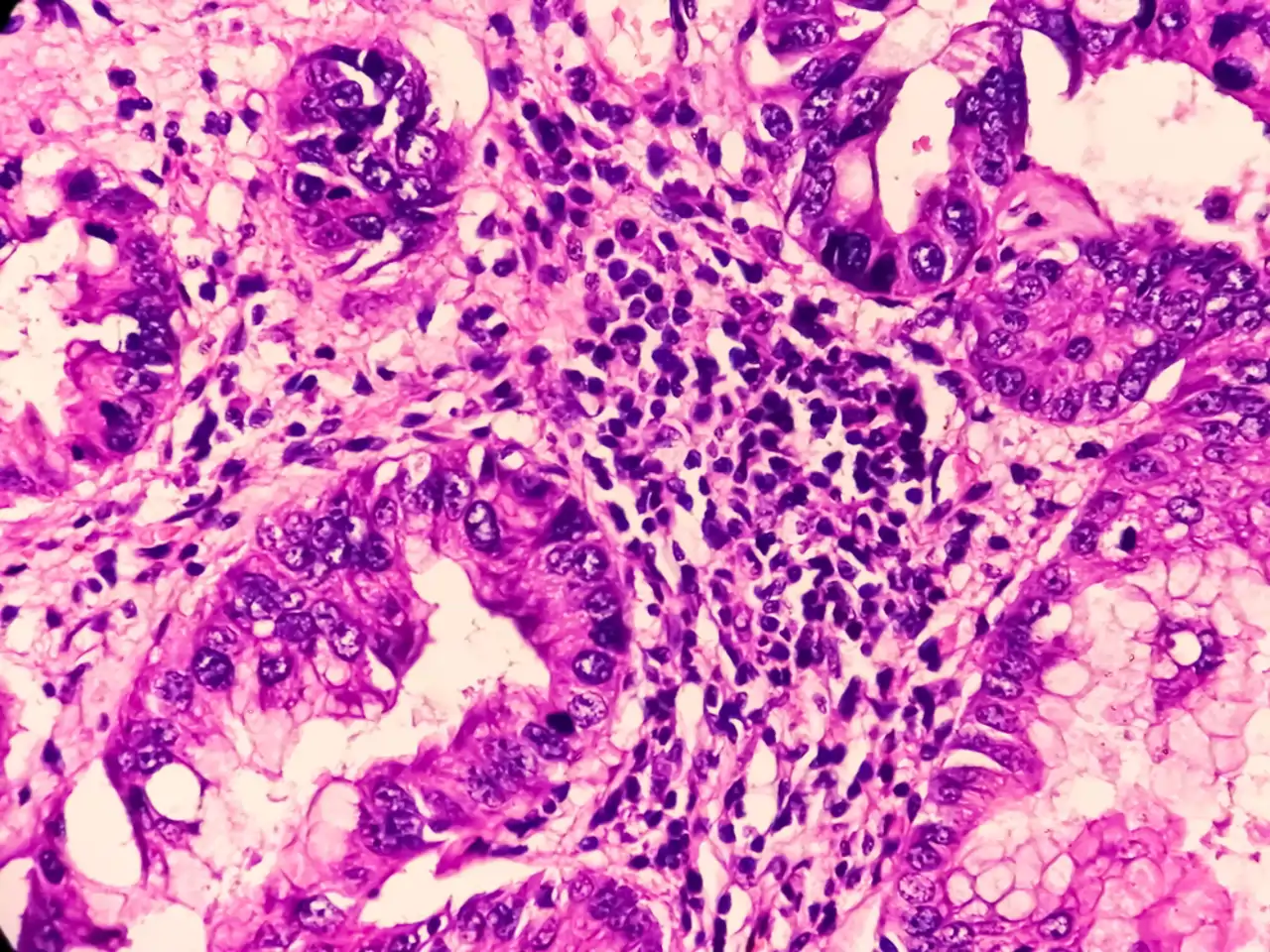 Cáncer de próstata