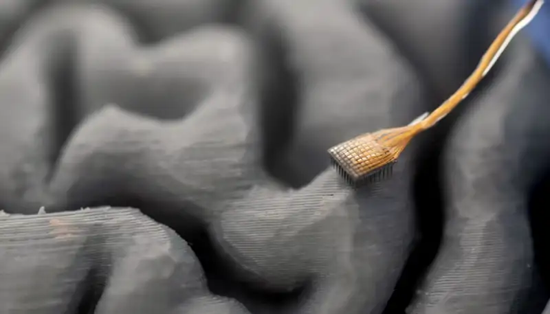 neuroimplante 3d