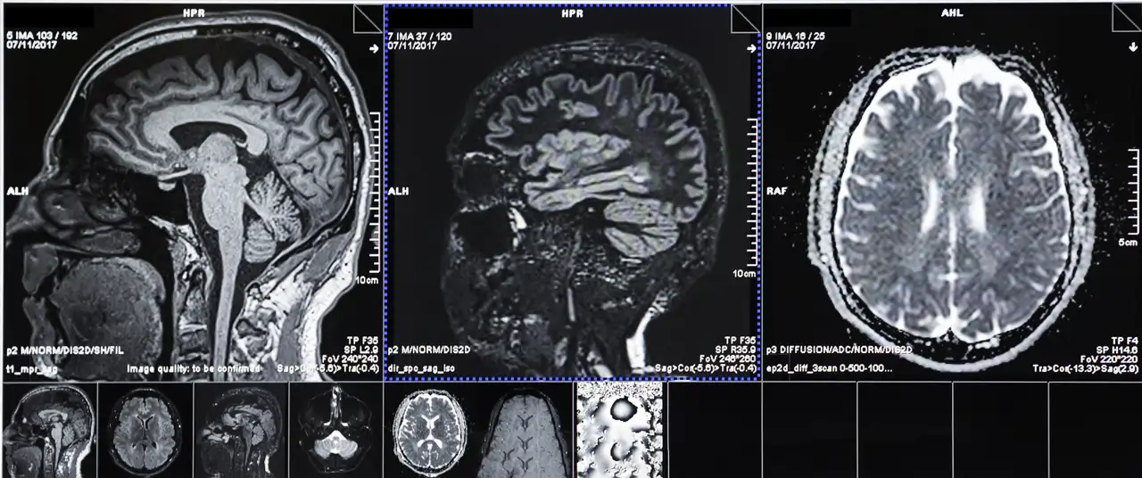 El cerebro puede envejecer más rápido que el cuerpo