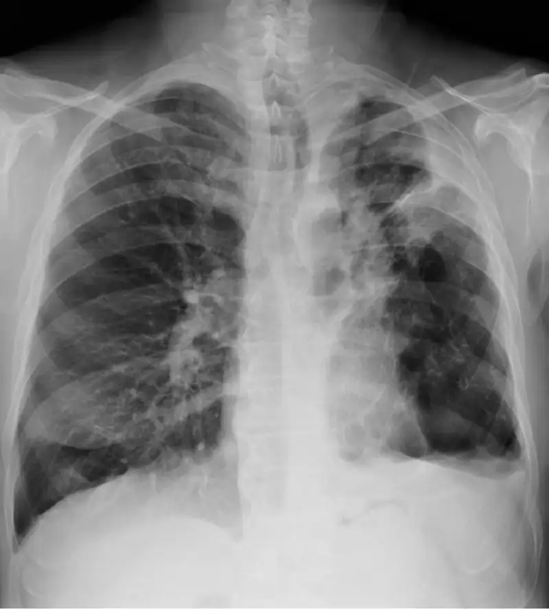 tuberculosis