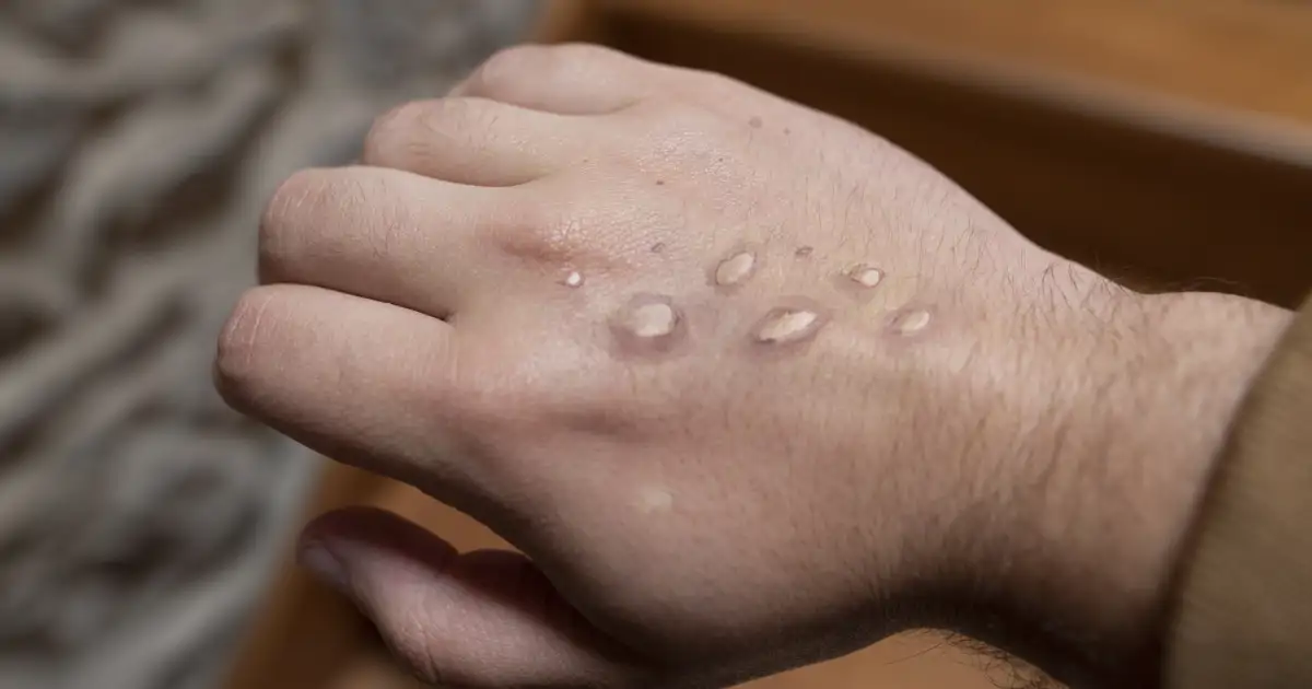 La viruela del mono evoluciona tras la emergencia internacional y en Baleares confirman el primer caso