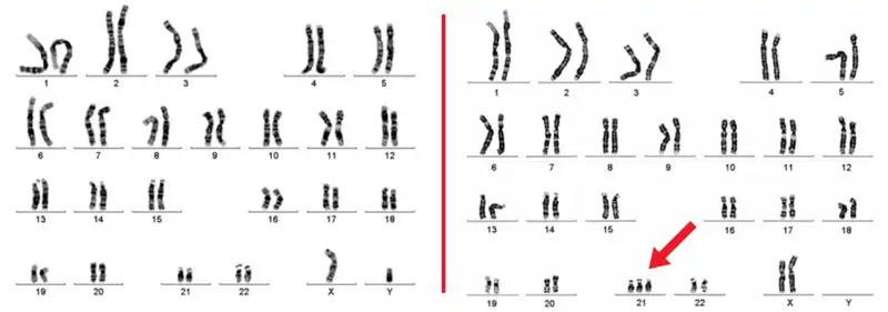 Genetica habitual y mujer con síndrome de Down
