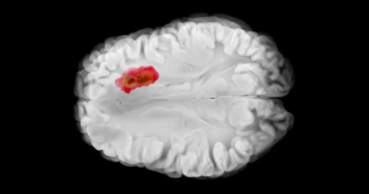 Cómo la melatonina podría ayudar contra el cáncer cerebral